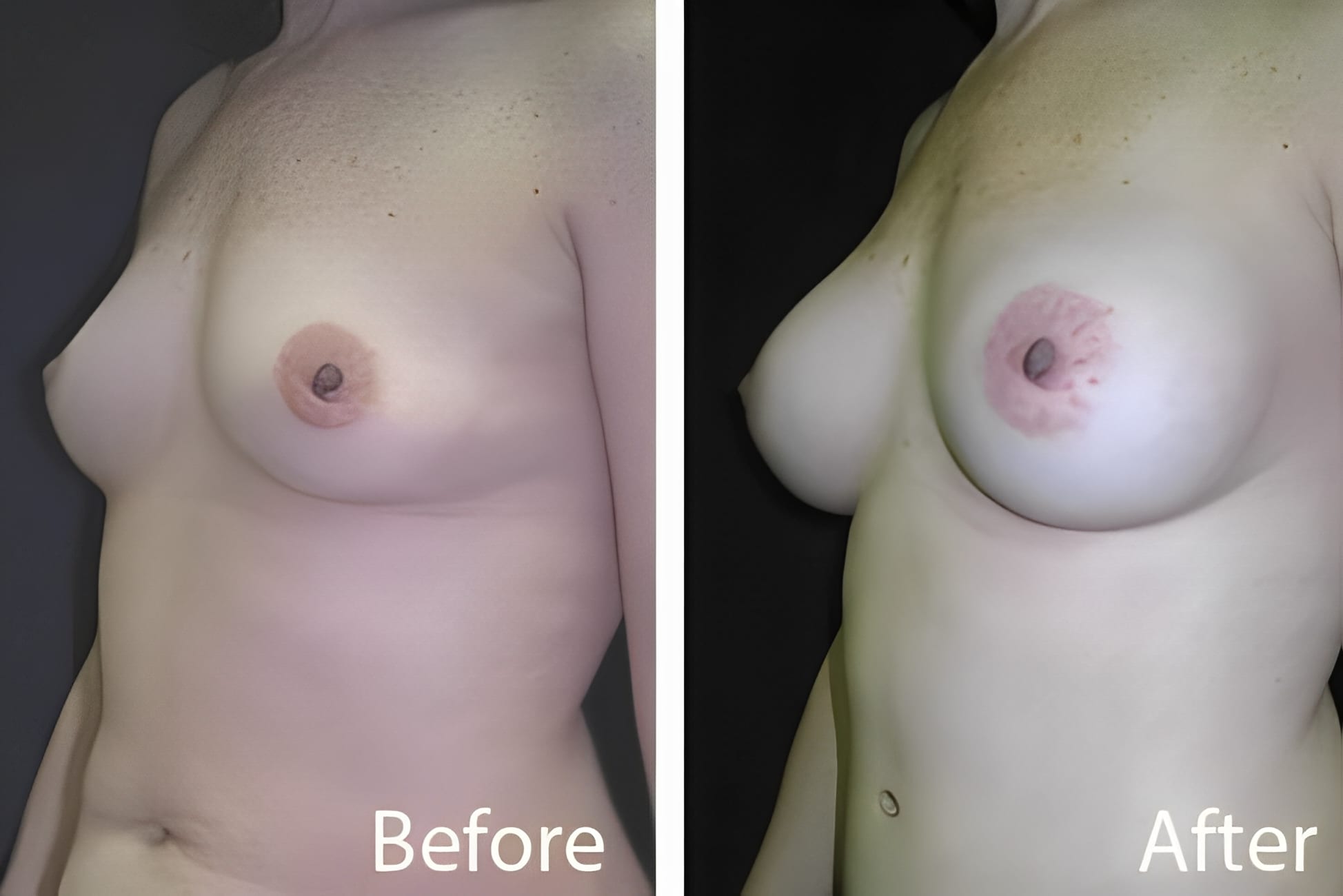 BA Breast Aug