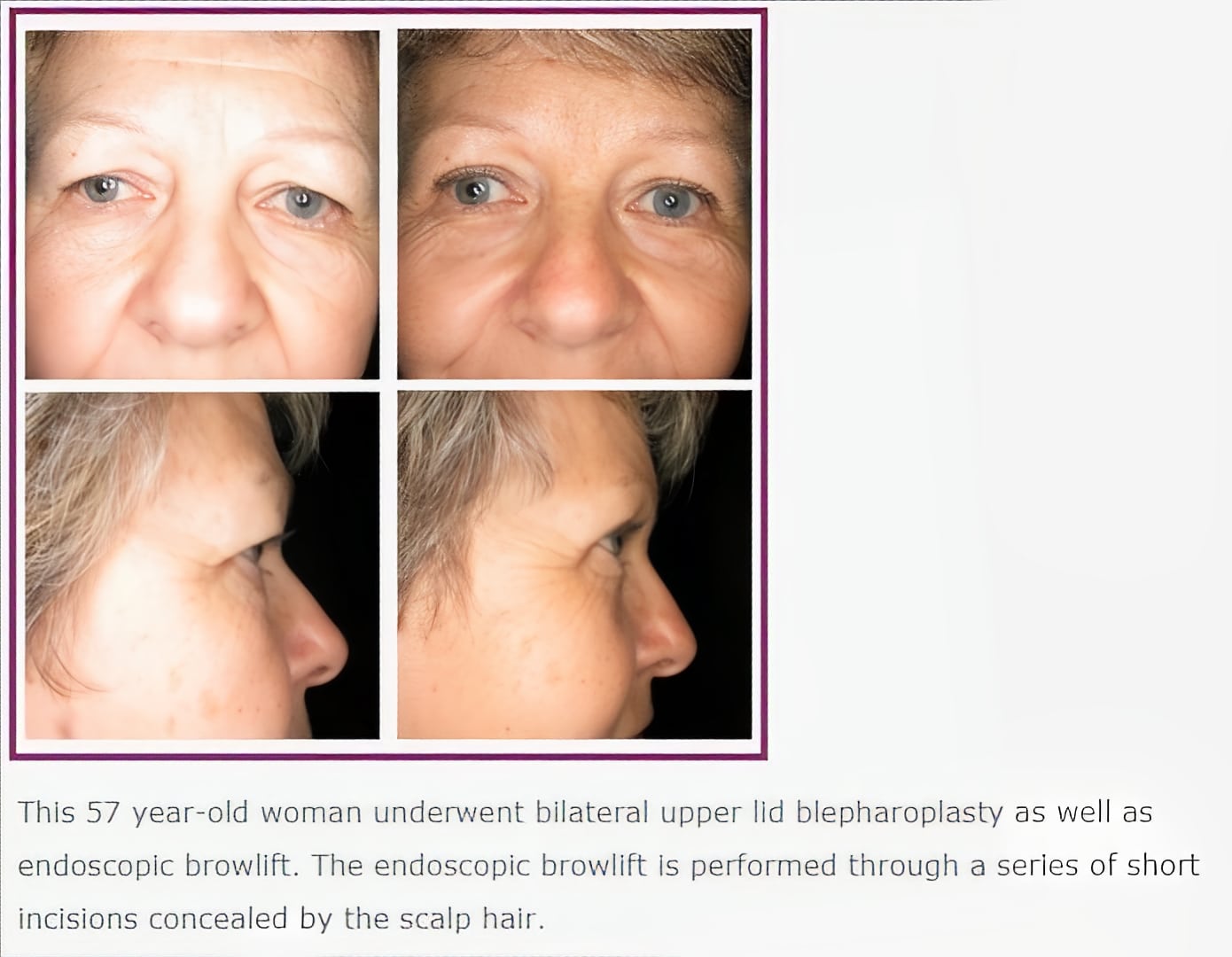 blepharoplasty eyelid surgery before after1