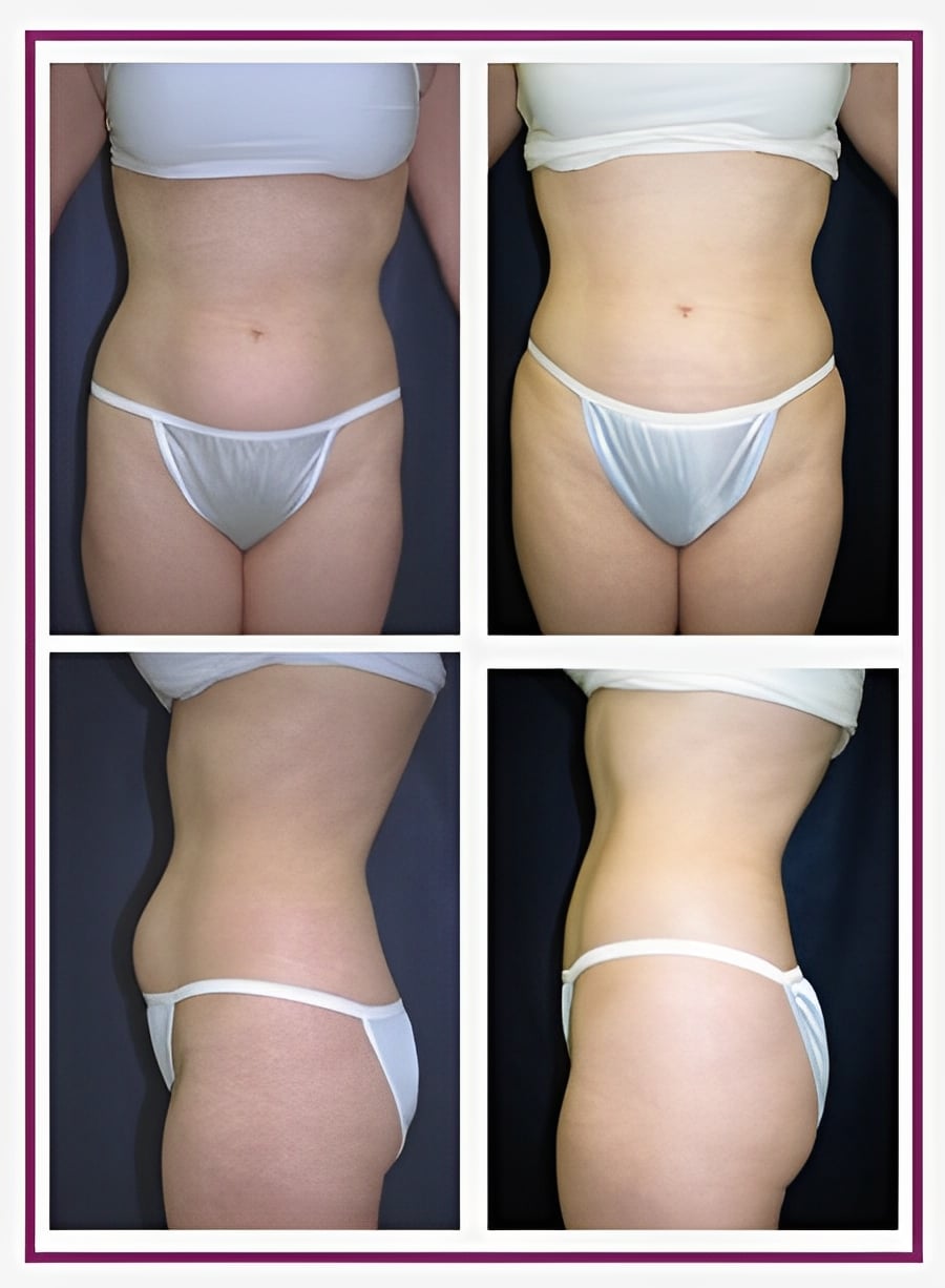 body lift female before after