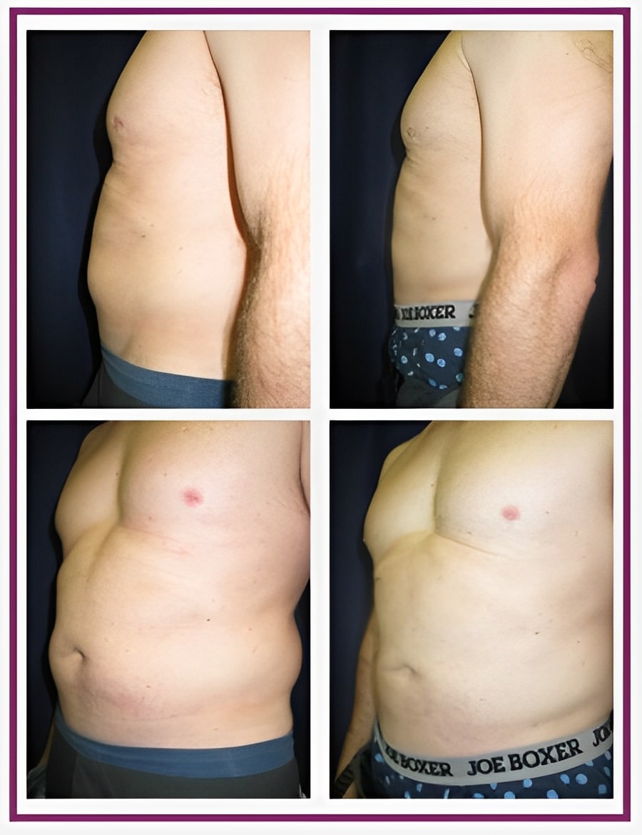 body lift male before after