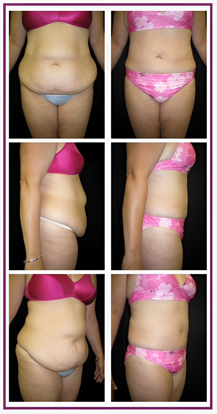 Boston Tummy Tuck Patient 1