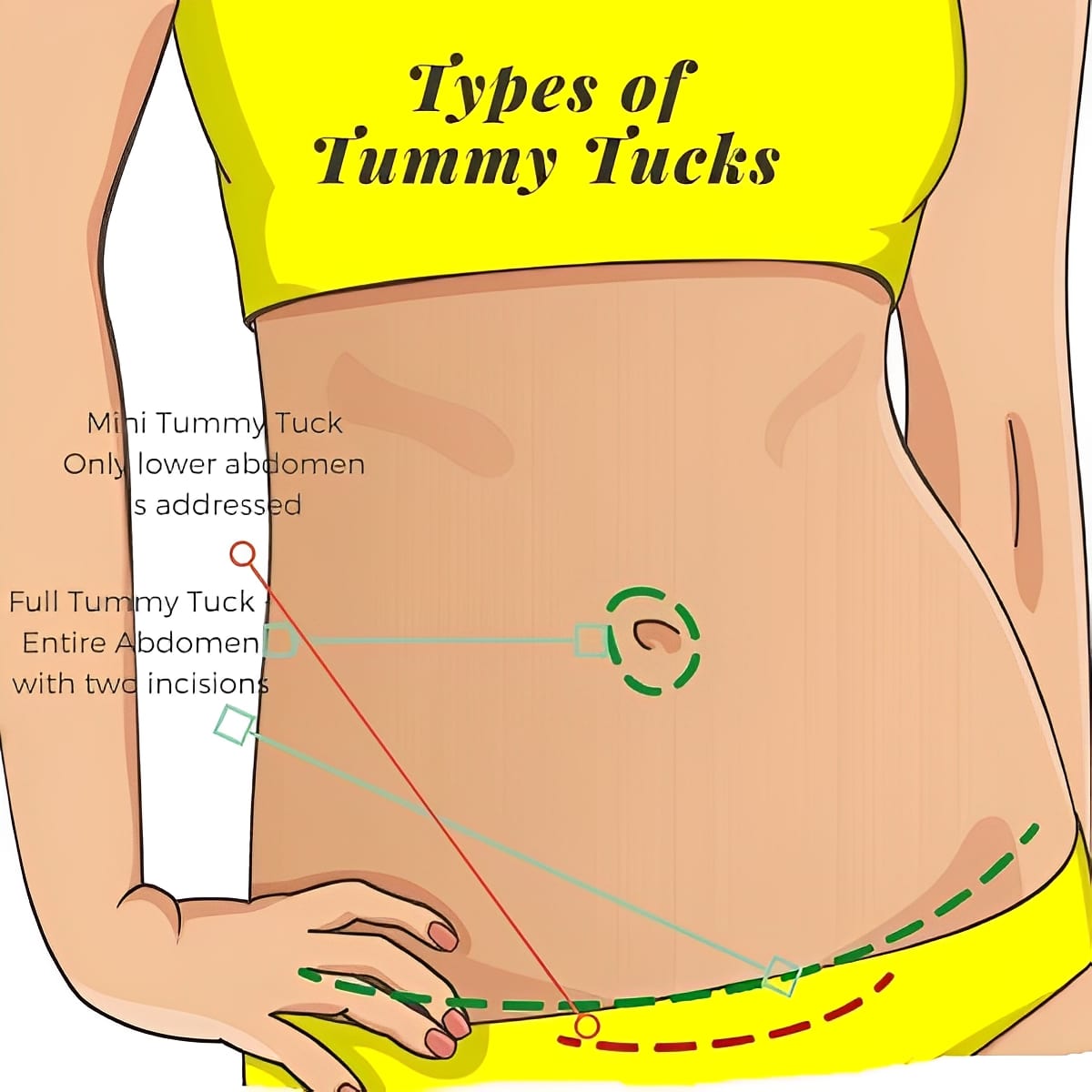 ChatsonGeorgeBostonTummyTuck