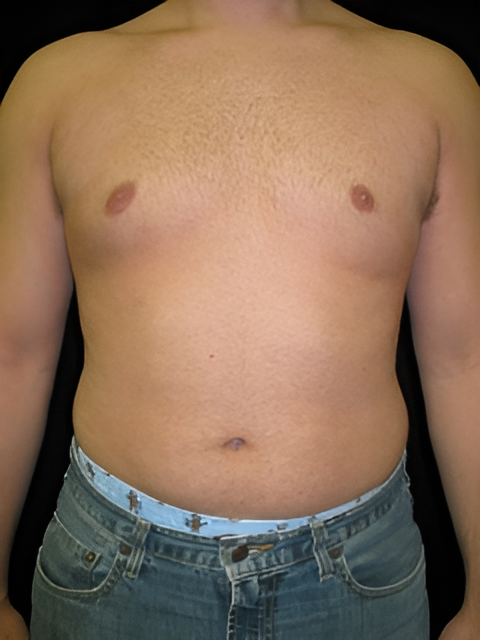 After Image: Gynecomastia - front