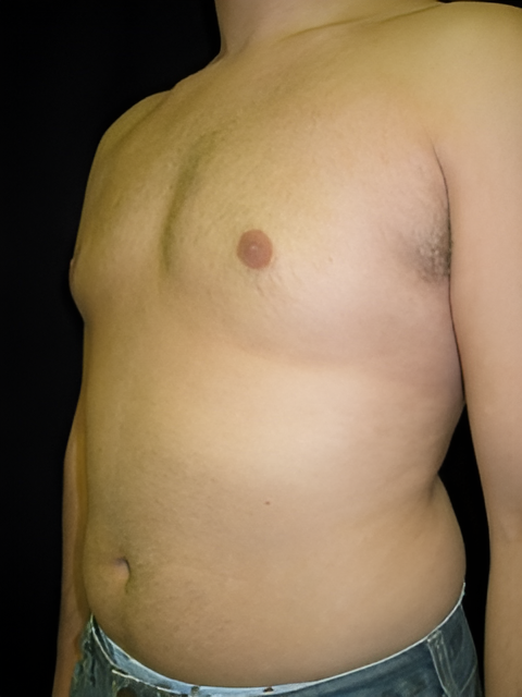 After Image: Gynecomastia - left-front-oblique