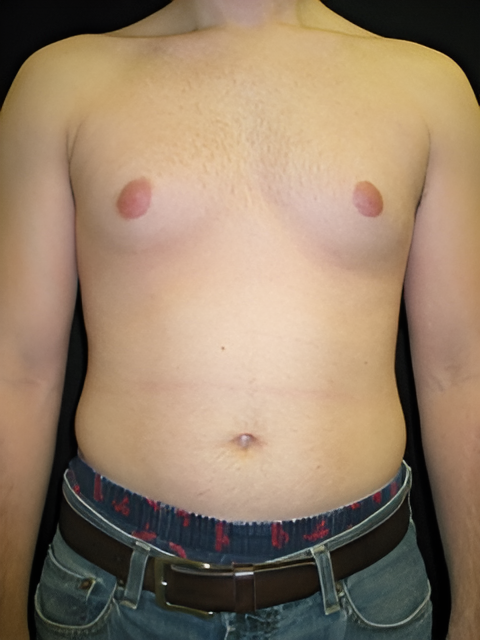 Before Image: Gynecomastia - front