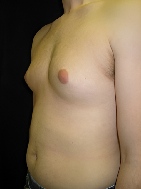 Before Image: Gynecomastia - left-front-oblique