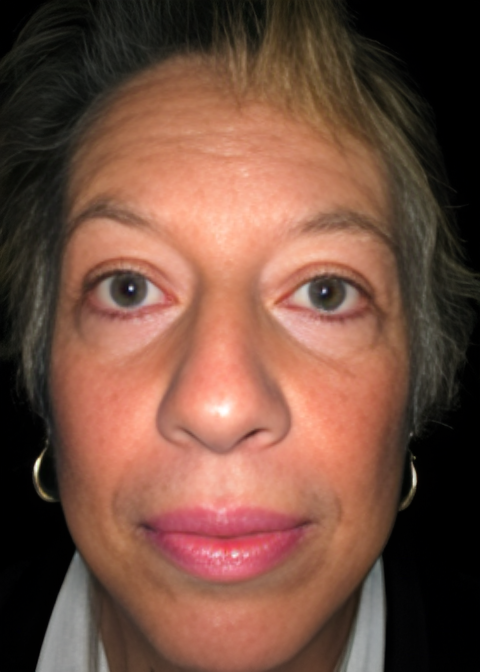 After Image: Facelift 2 - front