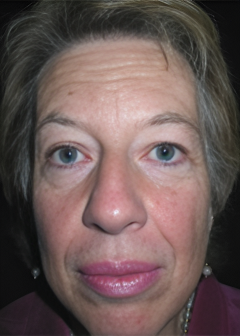 Before Image: Facelift 2 - front