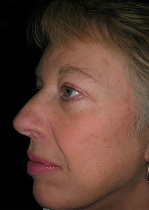 After Image: Facelift 2 - left-front-oblique