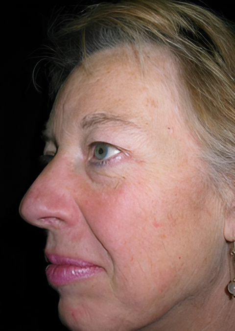 Before Image: Facelift 2 - left-front-oblique