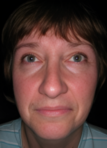 After Image: Rhinoplasty 2
