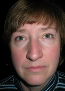 Before Image: Rhinoplasty 2