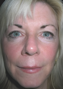 After Image: Facelift 1