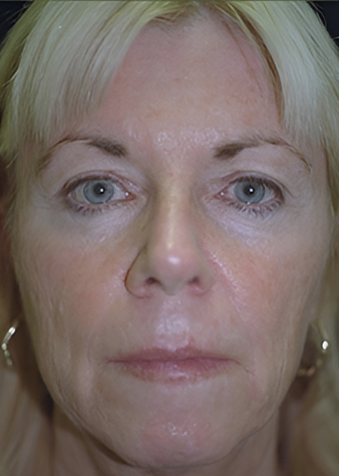 Before Image: Facelift 1 - front