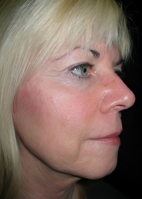 After Image: Facelift 1 - right-front-oblique