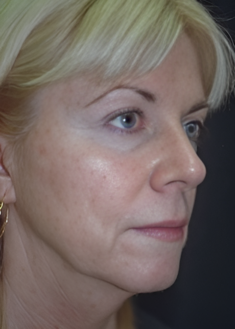Before Image: Facelift 1 - right-front-oblique