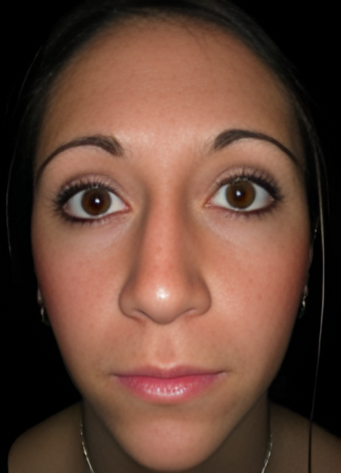 After Image: Rhinoplasty 3 - front