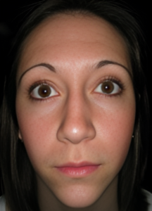Before Image: Rhinoplasty 3
