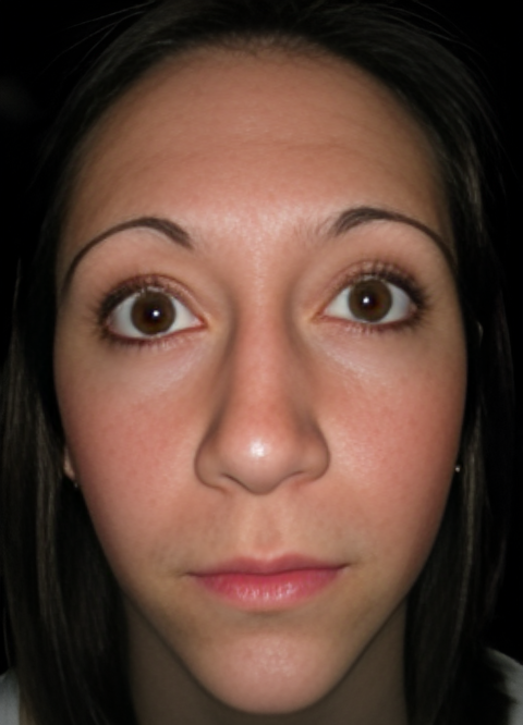 Before Image: Rhinoplasty 3 - front