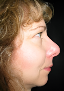 After Image: Rhinoplasty 1