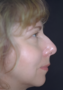 Before Image: Rhinoplasty 1
