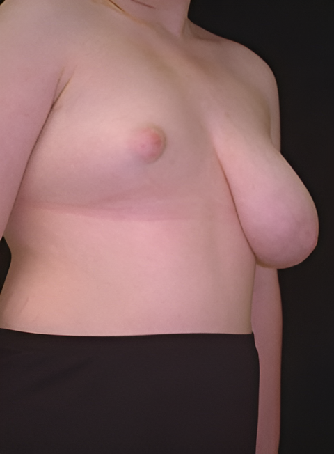Before Image: Breast Asymmetry 2 - right-front-oblique