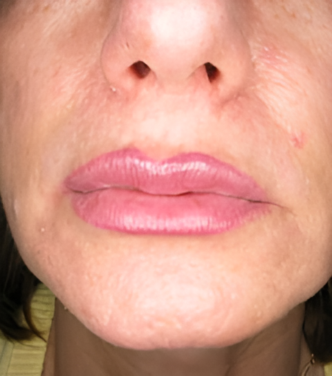 After Image: Lip Augmentation - front
