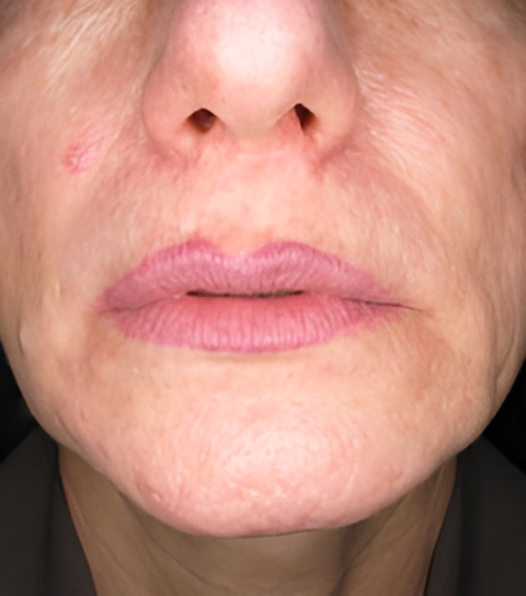 Before Image: Lip Augmentation - front