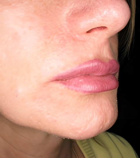 After Image: Lip Augmentation - right-front-oblique