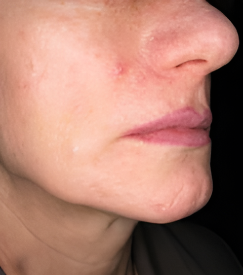 Before Image: Lip Augmentation - right-front-oblique